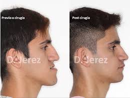 ✨✨✨Tomás: ”Bueno, es un proceso largo, pero vale absolutamente la pena. Uno  crece esperando poder llevar la cirugía a cabo, crees que el día no va a  llegar nunca, pero cuando