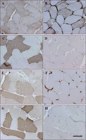 Necrotising myositis is a severe but rare form of acute invasive gas infection with high rates of morbidity and mortality. Tlr4 As Receptor For Hmgb1 Induced Muscle Dysfunction In Myositis Annals Of The Rheumatic Diseases