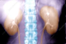 Image result for Intravenous Pyelogram