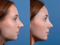 Dr Cochran in Dallas, Texas 75231 » Rhinoplasty: Cost, Pics, Reviews, Q&A