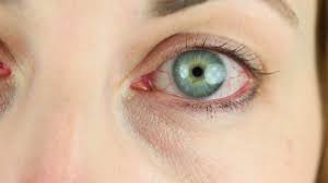Image result for Conjunctivitis Resources
