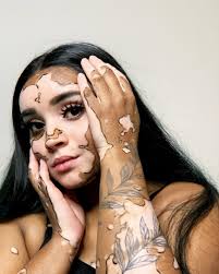 Image result for vitiligo model