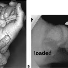 Image result for Scaphoid Shift Test