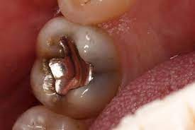 So here where i'm at we get mornings like these where the sun is barely rising and the air is cold and misty in the picture i guess someone is. Why Does My Tooth Hurt After Drinking Hot Or Cold Beverages Mccarl Dental Group