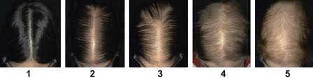 Here's what you need to know about spironolactone and hair loss. Innovative Use Of Spironolactone As An Antiandrogen In The Treatment Of Female Pattern Hair Loss Dermatologic Clinics