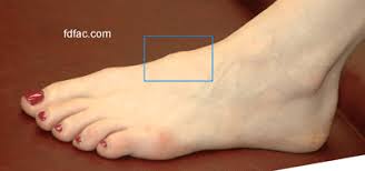 Is the bump or lump on your foot more than a bunion? Top Of The Foot Bump Dr Jenny Sanders Shoe Blog