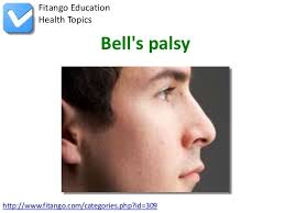 Some people refer to the condition as bell palsy. Bell S Palsy