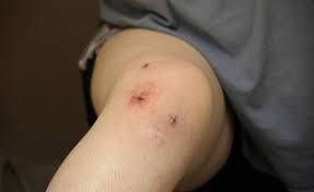 Knee Arthroscopy Surgery Reasons Risks Recovery Bonesmart Org