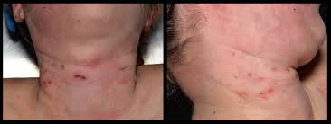 Image result for Strangulation Injury