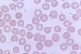 Image result for G6PD Deficiency
