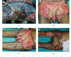 About one per 62,500 males are affected per year. Figure 2 From Neglected Fournier S Gangrene Caused By Acinetobacter Baumannii A Rare Case Report Semantic Scholar