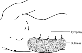 Image result for Shifting Dullness Test