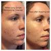 Simple brand face wash for acne. 1