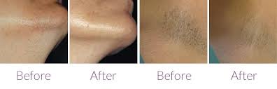 The way it works is simple. Laser Hair Removal Perfection Skin Beauty Clinic