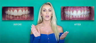 After that, switch to wearing it at night, every night, if you want to keep if you had braces done as a kid, it is recommended to keep the permanent retainer for at least 10 years. Byte Reviews Clear Teeth Aligners Do They Work 2021