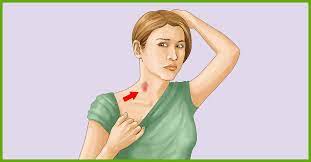 To avoid embarrassment you can cover up and hide a hickey with clothing or makeup and you can also use home remedies to get rid of hickeys fast. How To Get Rid Of A Hickey 13 Simple Ways
