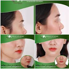 Cân chỉnh ngũ quan trên gương mặt trở nên hài hòa hơn bằng cách cải thiện