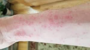 This caterpillar identification guide is accurate and easy to use. How I Treated My Browntail Moth Rash Shtf Blog Modern Survival