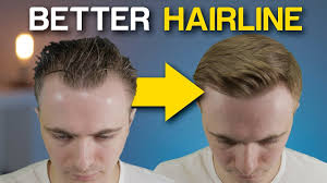 This type of hair loss can result in a widow's peak. 5 Powerful Receding Hairline Tricks To Instantly Improve Your Look Youtube