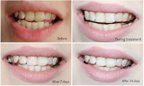 Teeth As White As Snow Smile Lab Advanced Teeth Whitening