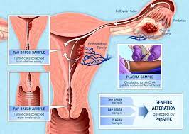 Ovarian cancer warning signs include ongoing pain or cramps in the belly or back, abnormal vaginal depending on the cancer stage, ovarian cancer treatment includes surgery and chemotherapy. Papseek Test For Endometrial And Ovarian Cancer National Cancer Institute