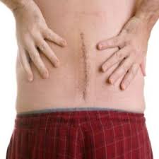 Lifestyle Changes After Back Surgery Ugh Not Looking Forward To This Spinal Surgery Spinal Fusion Spine Surgery