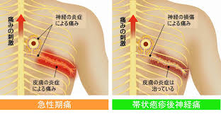 Primary infection usually occurs in childhood, producing. å¸¯çŠ¶ç–±ç–¹å¾Œç¥žçµŒç—›ç—‡çŠ¶ã‚„åŽŸå›  æ²»ç™‚ã«ã¤ã„ã¦ èŒ¨æœ¨å¸‚ã®ãƒšã‚¤ãƒ³ã‚¯ãƒªãƒ‹ãƒƒã‚¯ ã‚‚ã‚‚ãŸã‚ã†ç—›ã¿ã®ã‚¯ãƒªãƒ‹ãƒƒã‚¯