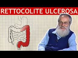 Nella dieta consigliata per la colite ulcerosa è preferibile ingerire cibi a basso contenuto di grassi perché l'assorbimento e la digestione dei grassi potrebbe essere faticosa. Dott Mozzi Rettocolite Ulcerosa E Morbo Di Crohn Youtube