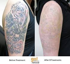 Pin By Carmenk On Tatu Plakat Sleeve Tattoos Laser Tattoo Removal Tattoo Removal