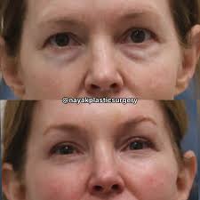 🤌🤌Plastic surgery doesn't have to look plastic. 😍😍Margot is 58 years  old. She is almost 4 months postop deep plane facelift, deep necklift, brow  lift, upper blepharoplasty, lower blepharoplasty, corner lip reset,