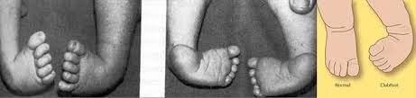 Babies who are born with a foot that's twisted inward and downward have a birth defect called clubfoot. Clubfoot Children S Orthopaedic And Scoliosis Surgery Associates Llp