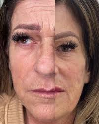 Seventy Hyal 2000💫 Hydrate💦 Glow✨Contour💉