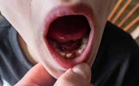 Image result for Dry Socket