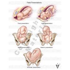 Image result for Shoulder Presentation