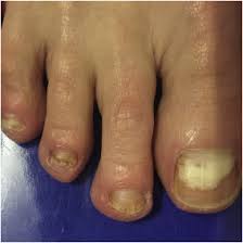 Image result for Onychotillomania feet