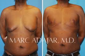 Image result for Mastectomy