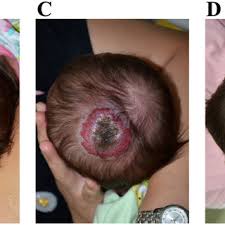 Loss of appetite nausea passing gas rash relaxed and calm sleepiness stomach pain stomach soreness or discomfort stuffy nose vomiting weight loss other side effects not listed may also occur in some patients. Pdf Intolerable Side Effects During Propranolol Therapy For Infantile Hemangioma Frequency Risk Factors And Management