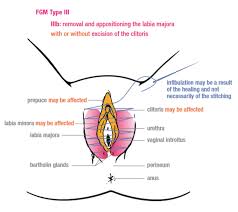 Neben diesen vier von der who definierten typen gibt es weltweit viele weitere formen von fgm/c. Https Www Newsd Admin Ch Newsd Message Attachments 64058 Pdf
