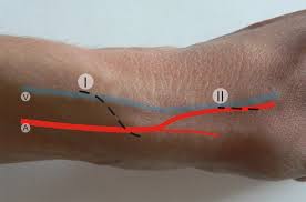 The Snuffbox Fistula Should Be Preferred Over The Wrist Arteriovenous Fistula Journal Of Vascular Surgery *anatomical snuff box is a triangular depression on the lateral aspect of wrist immediately distal to the radial styloid process, that becomes prominent when thumb is fully extended. wrist arteriovenous fistula