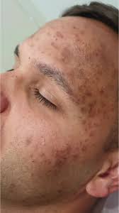 Image result for Postinflammatory Hyperpigmentation