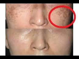 これは衝撃 ひまし油の効果がヤバかった 育毛 発毛 ヘアケア 毛 の救世主が現れる 男女必見 youtube ひまし油 肝斑 手作りスキンケア