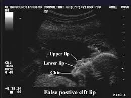 Pin On Cleft Lip