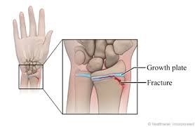 Image result for Hand Growth Plates