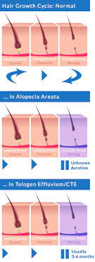 The process of hair expansion in wet conditions and contraction under dry conditions is both stressful and damaging to the hair fiber over time. 6 Conditions That Make You Constantly Tired And Cause Hair Loss