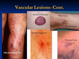 I know that purpura is elevated and that spider angiomas (easly recognizable) refill from the center to the periphery when pressure is applied. Integumentary System N210 Rachel Natividad Rn Msn Np Ppt Download