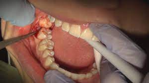 First Cosmetic Dentistry Website Dentistappointment Dentalhygienistcup Wisdom Teeth Wisdom Tooth Extraction Wisdom Teeth Pulled