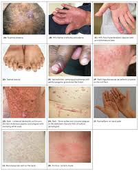 Melanoma, the most serious form of skin cancer, is not as common as the other two major types of skin cancer, accounting for approximately 62 of new melanoma cases has been steadily increasing over the past several decades, early detection and treatment of the disease is very important. Canadian Skin Management In Oncology Casmo Algorithm For Patients With Oncology Treatment Related Skin Toxicities