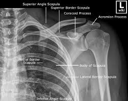 Scapula Radiographic Anatomy Wikiradiography Radiology Student Radiology Imaging Radiology Technician