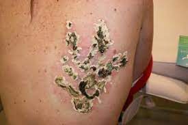 Why do i get blisters from laser tattoo removal? Tattoo Removal Rejuvi Laser London Surrey Croydon