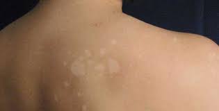 Sunlight makes life possible, but it can have an unexpected effect on your skin. Remove Pesky White Sunspots With These 8 Simple Home Remedies